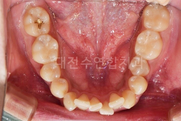 임플란트 사진 1