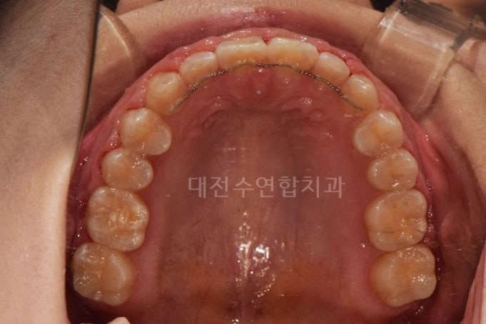 임플란트 사진 4
