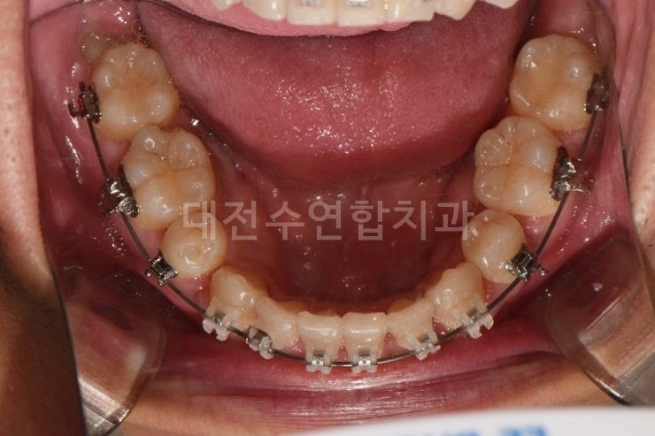 치아교정 사진 4