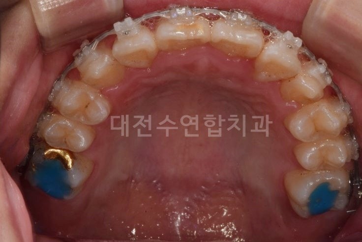 치아교정 사진 1