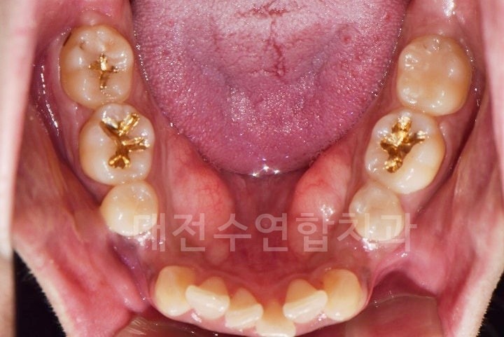 치아교정 사진 4