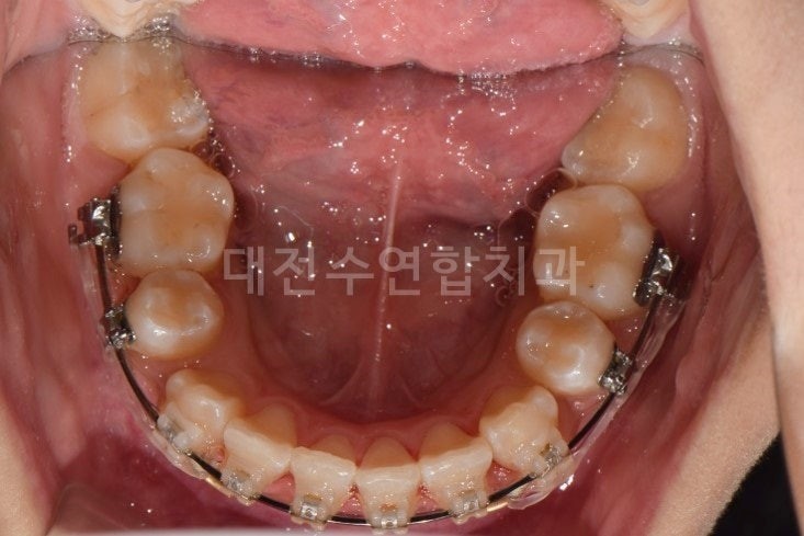 치아교정 사진 3