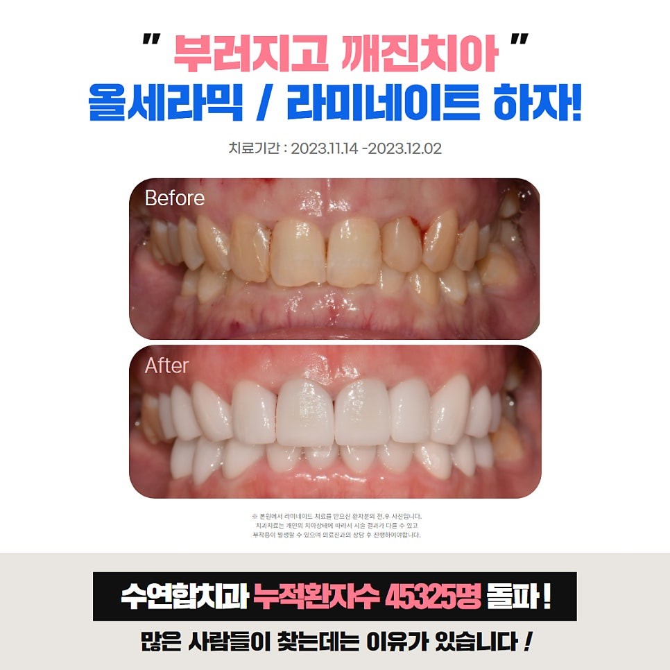 라미네이트 전 확인하는 치아 조건과 삭제량 기준은 무엇일까 - 대전라미네이트 - 수연합치과